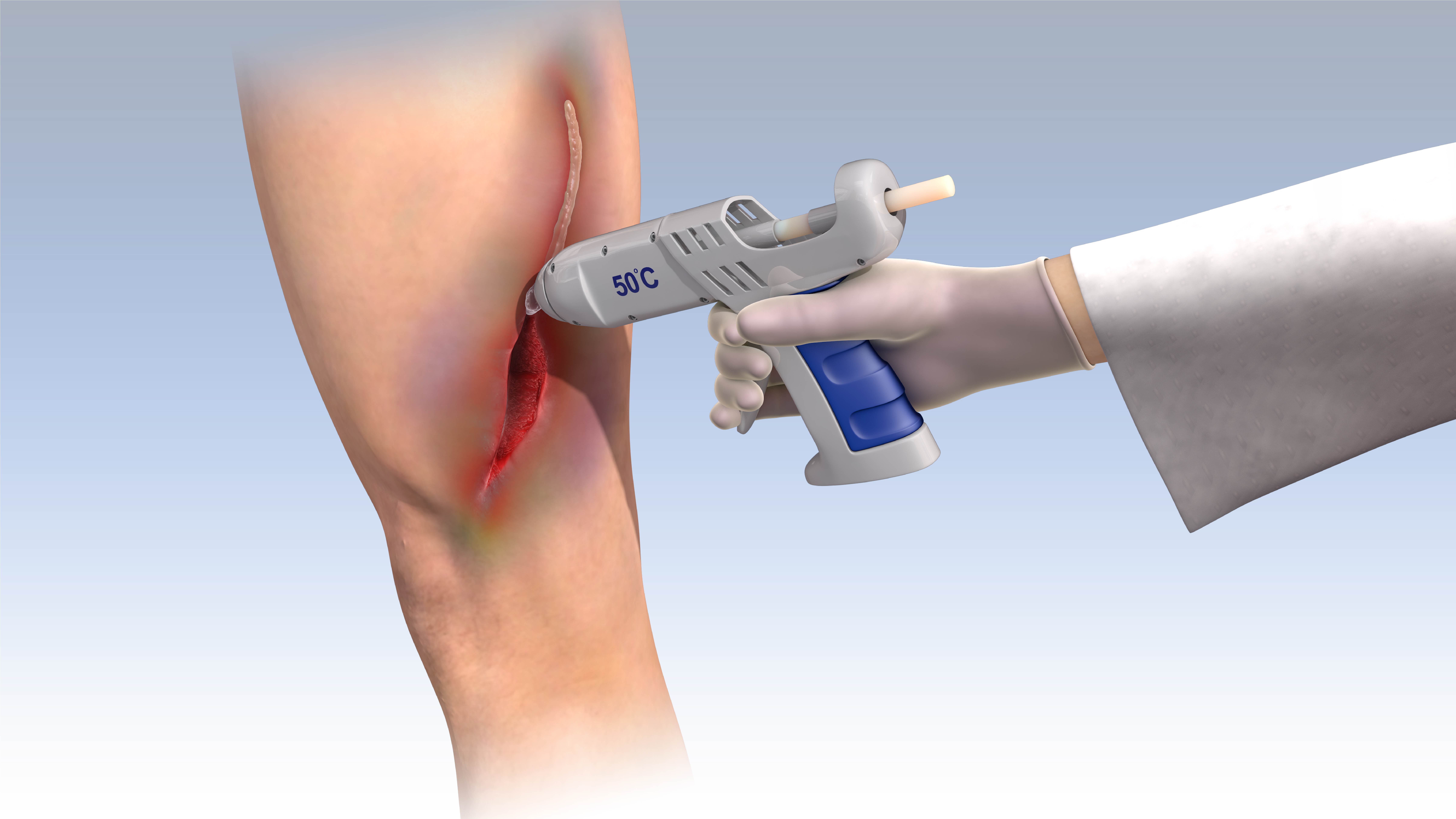 Hot Glue Gun Releasing Biocompatible Tissue Adhesive