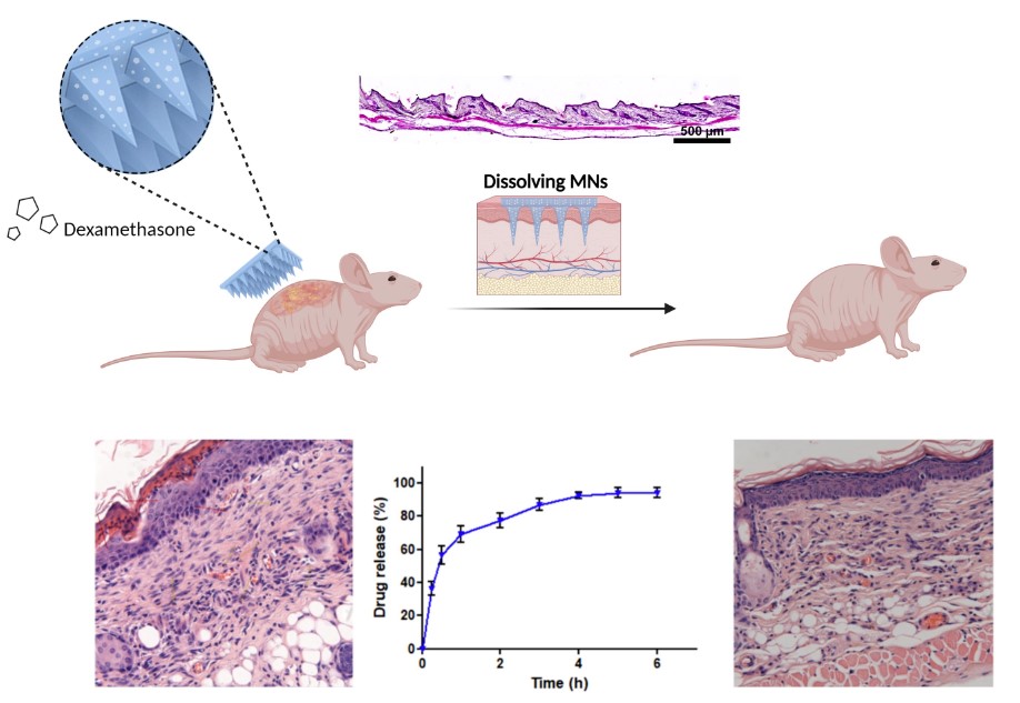 Design and Evaluation of Dissolvable Microneedles for Treating Atopic Dermatitis